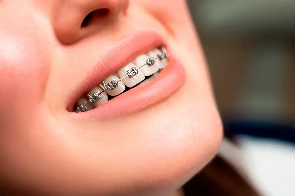 Brackets 