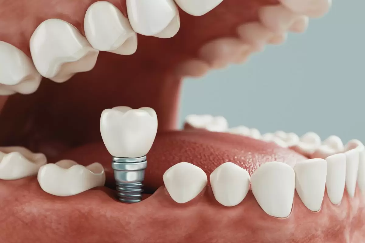 Cuanto cuesta implante dental precios 2024
