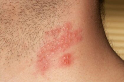 herpes zoster