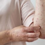 Alerta epidemiológica en Argentina: Salud confirmó el primer caso de sarampión de 2026