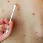 Salud: Se confirmó el primer caso de sarampión del 2026 en el país