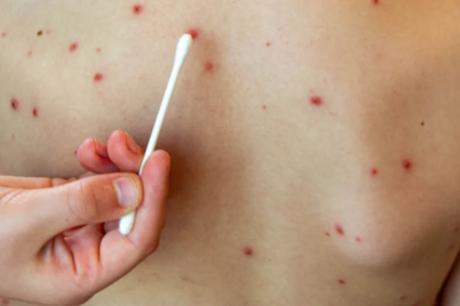 El Ministerio de Salud cerró el brote de sarampión en Buenos Aires tras 20 semanas sin casos