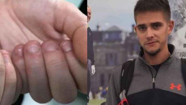 ¡a tener cuidado! Un joven casi muere por morderse las uñas