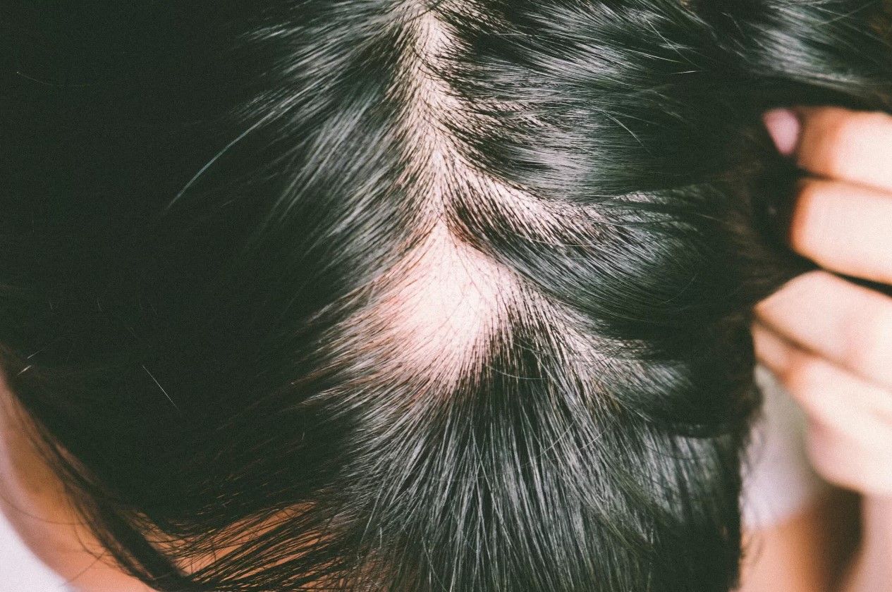 alopecia-en-mujeres-areata-causas
