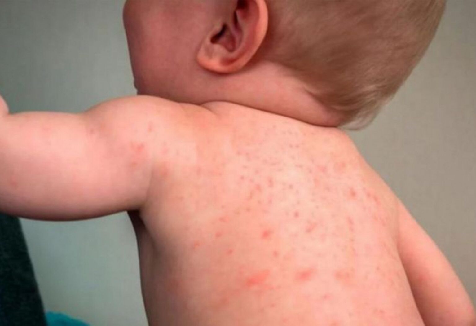 Confirmaron un caso de sarampión en una nena de 2 años