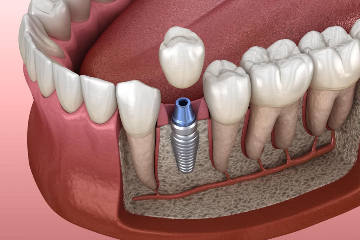 cuanto-cuesta-implante-dental-argentina