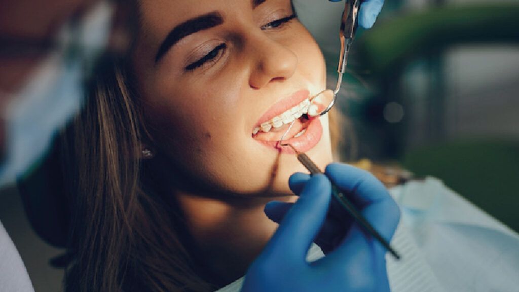 Cuánto cuesta ponerse brackets en Argentina Precios 2023
