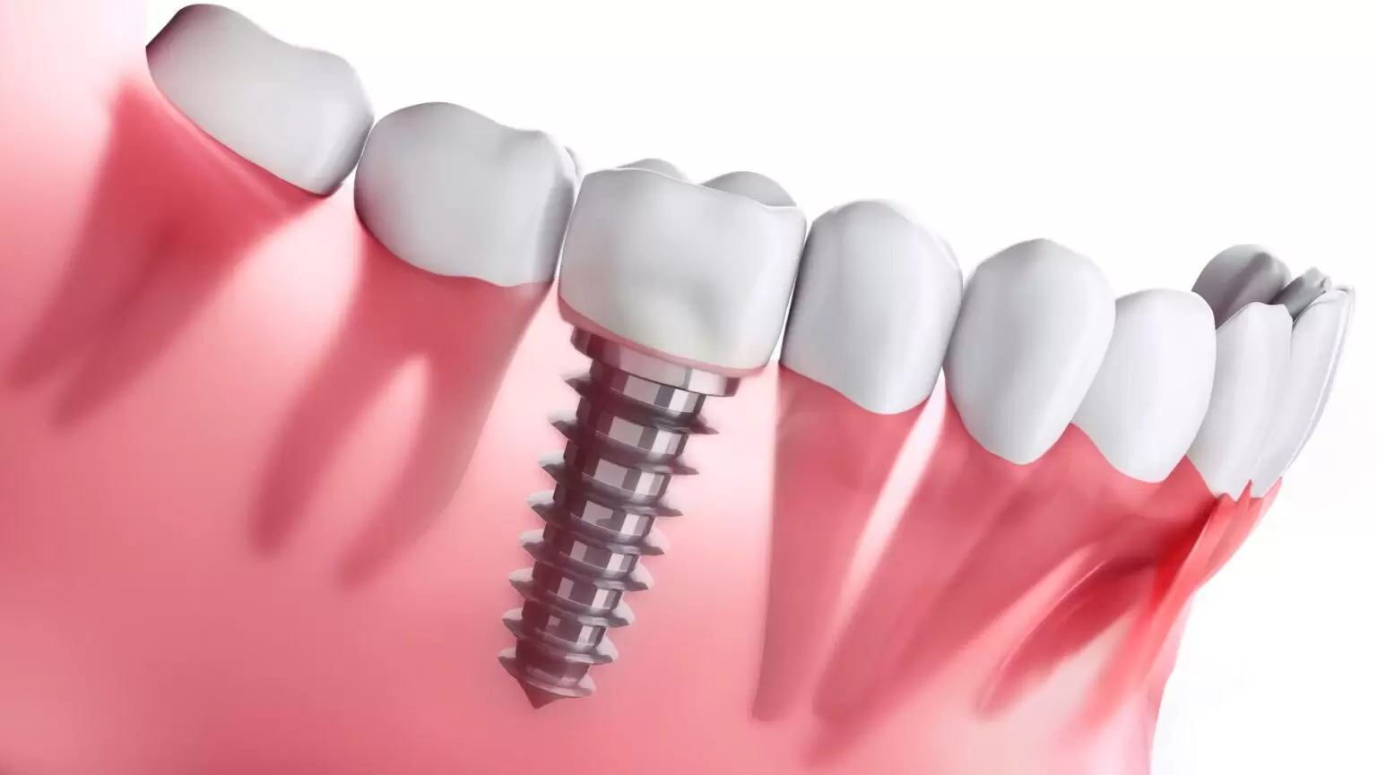 Implantes dentales precios 2023 ¿Cuánto cuesta en Argentina?