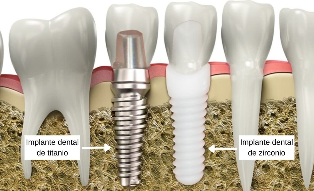 Titanio vs. Zirconio