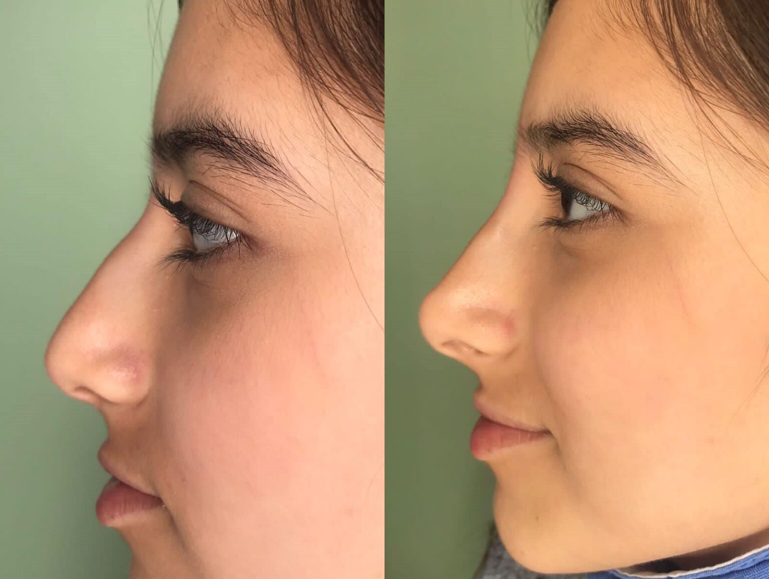 cuanto cuesta una rinomodelacion en argentina 2024