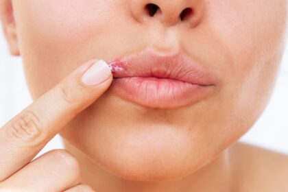 Que provoca el Herpes Labial las causas y como prevenirlo