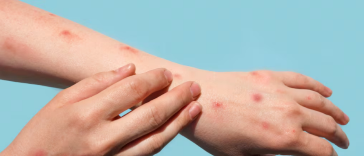 Crece la preocupación por el aumento de casos de viruela del mono en argentina