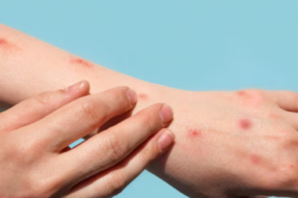 Crece la preocupación por el aumento de casos de viruela del mono en argentina