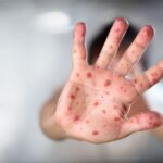 Finalizó el brote de sarampión en Provincia tras 20 semanas sin nuevos contagios