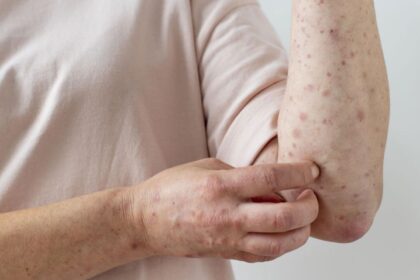 El Gobierno de la provincia de Buenos Aires activa alarma por nuevo brote de sarampión