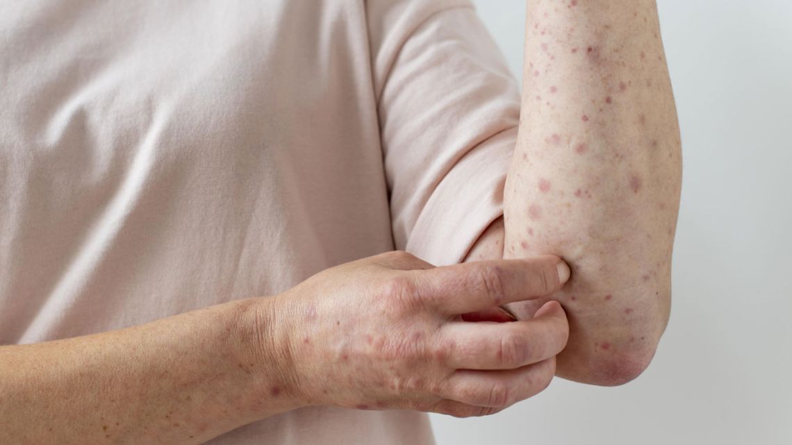 El Gobierno de la provincia de Buenos Aires activa alarma por nuevo brote de sarampión