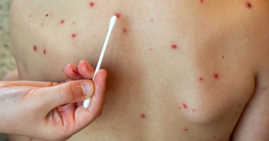 El Ministerio de Salud cerró el brote de sarampión en Buenos Aires tras 20 semanas sin casos