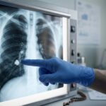 Diagnóstico tras la cirugía del papa león xiv: qué es el adenocarcinoma pulmonar y cuál es su pronóstico